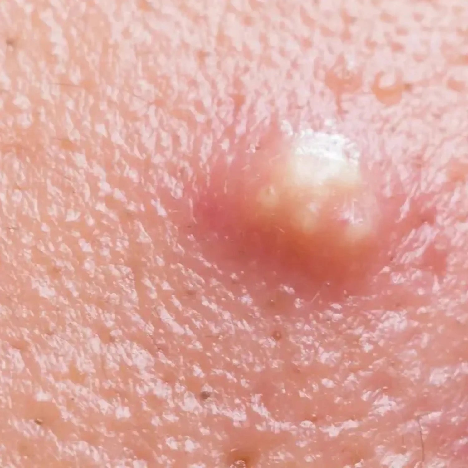 Furunkel im Intimbereich