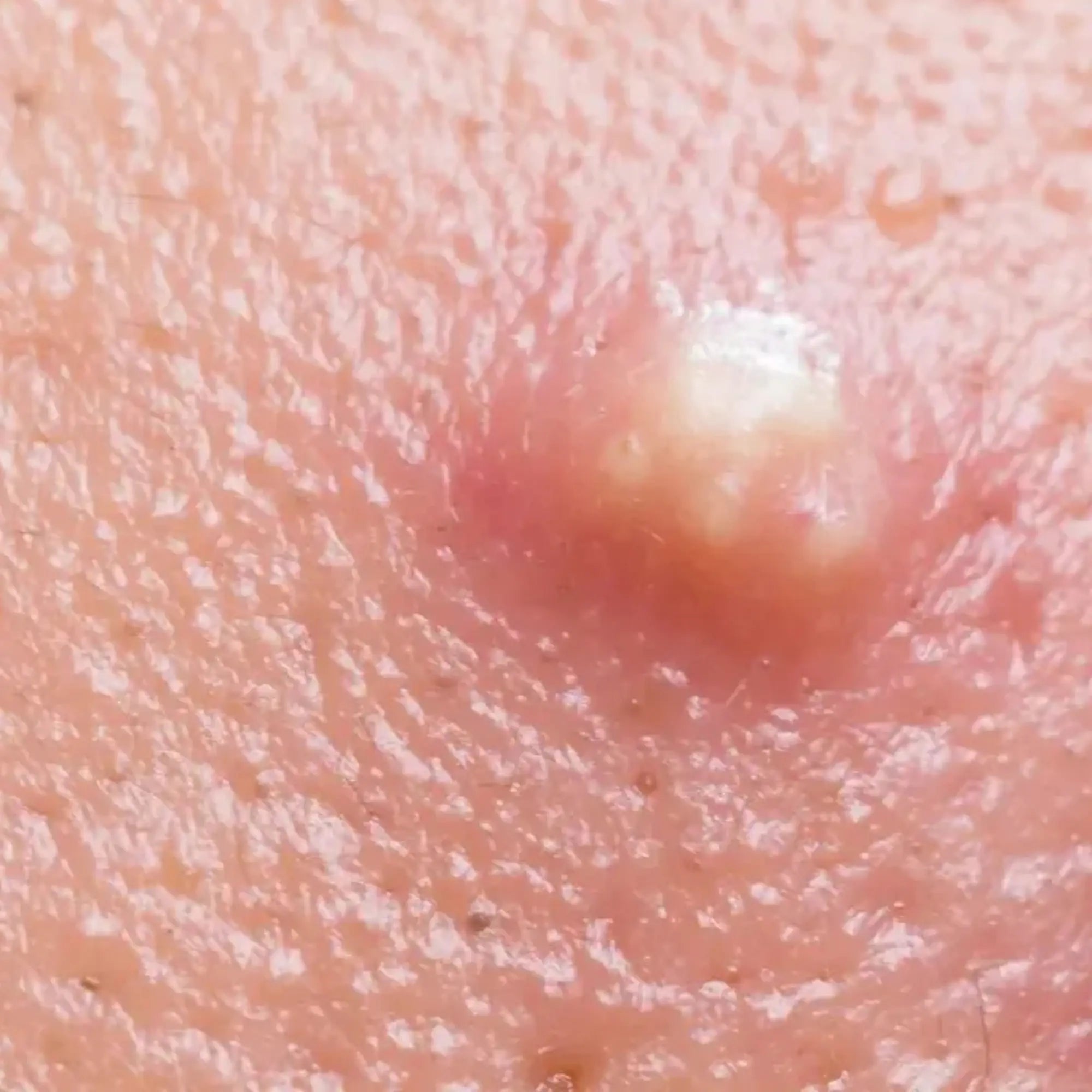 Furunkel im Intimbereich